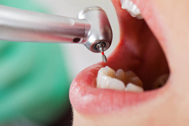 Best Chipped Tooth Repair Near Me  in Wurtland, KY